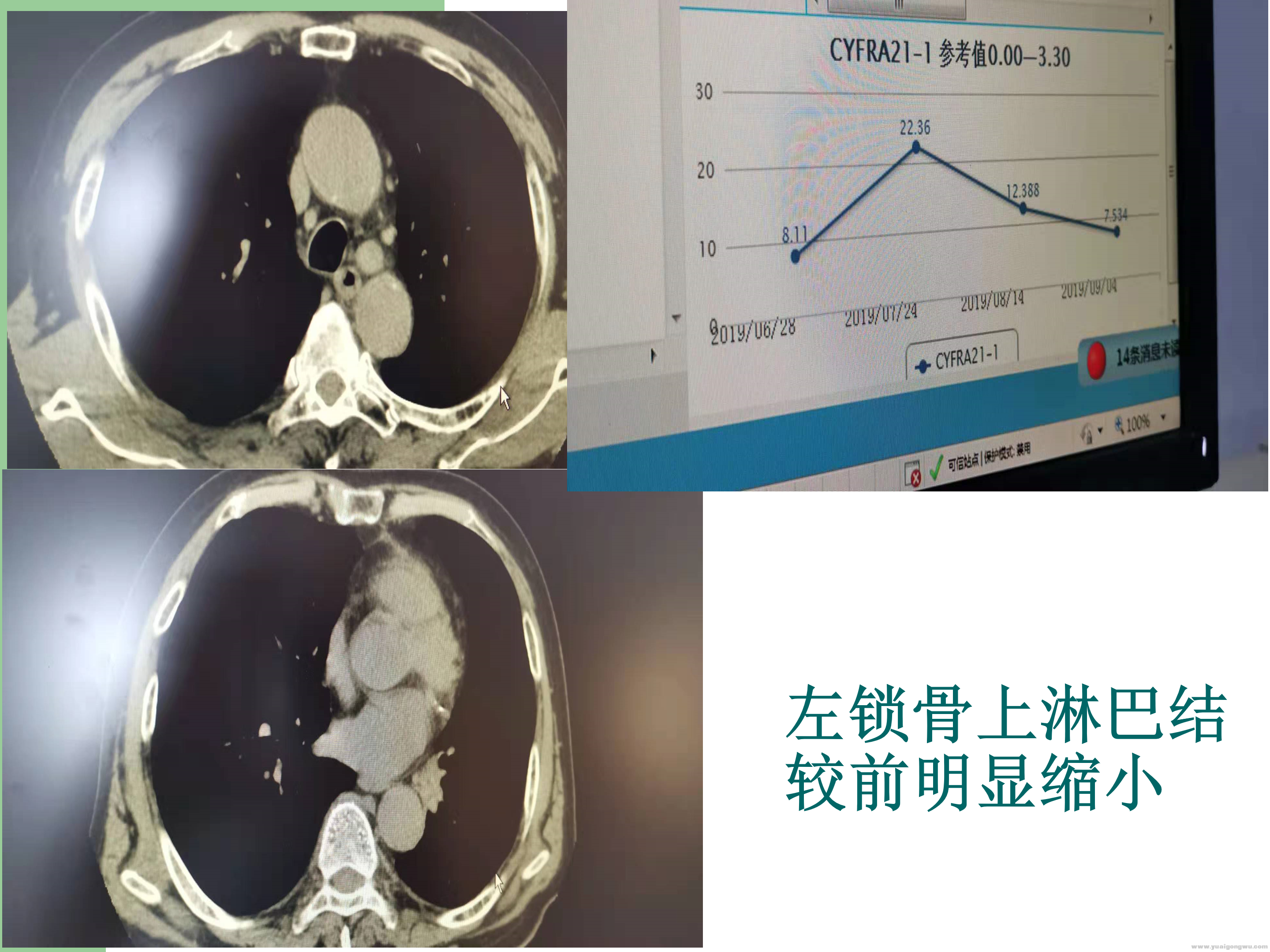 PD1病例分享_14.png